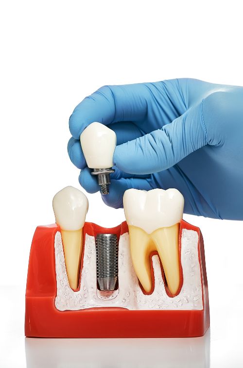 Dental_Implants_faq
