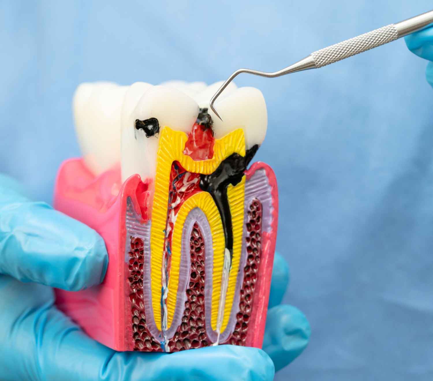 root canal 1