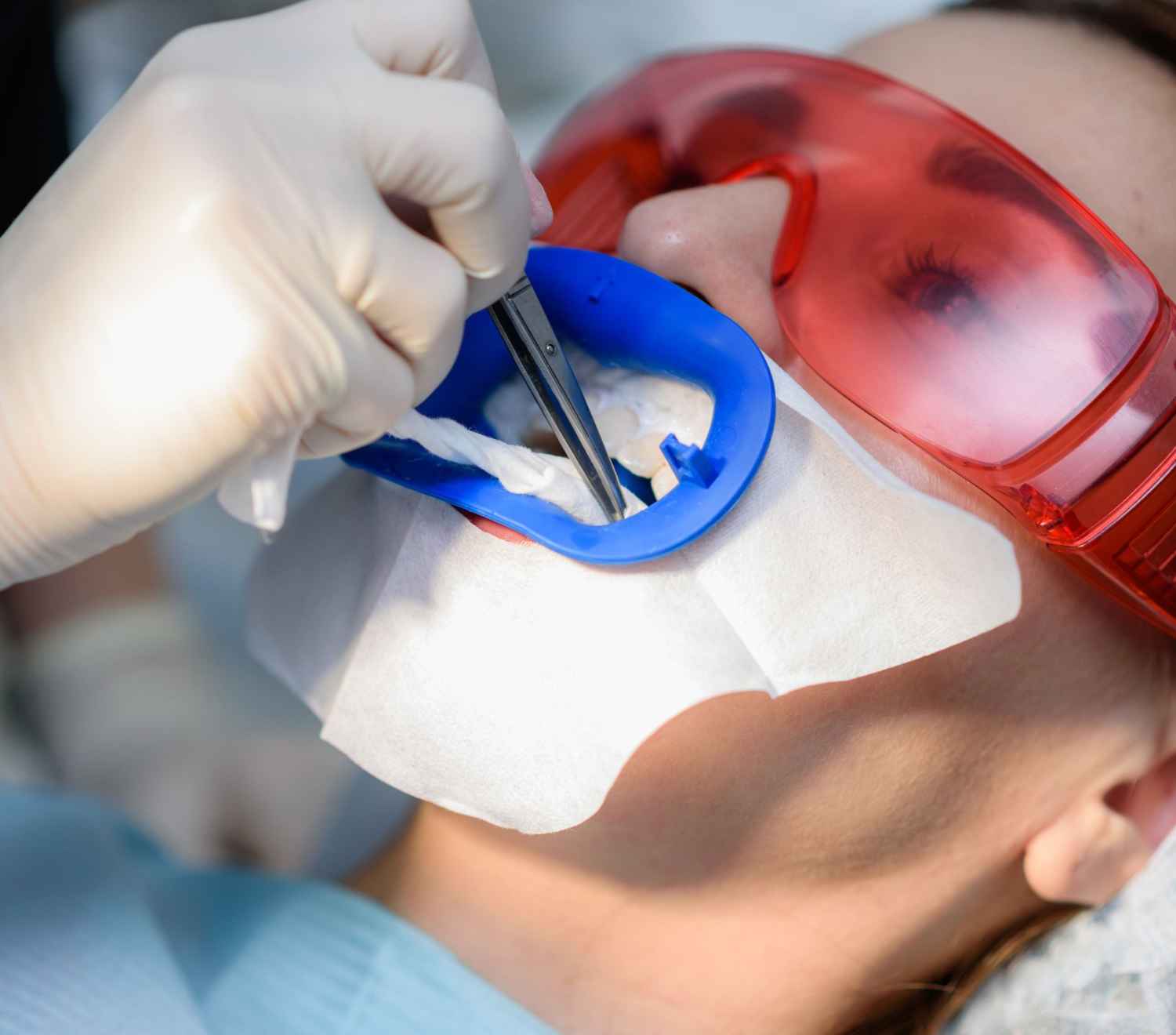 tooth extraction 1